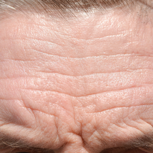 Anti Wrinkle Treatment Botox